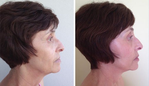 facelift photo